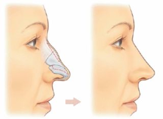 операция на горбинку носа